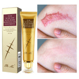 Acne Scar Removal Cream Repair Stretch Marks Gel Remove Burn Scars Surgical Scar Repair Treatment Smoothing Body Skin Care 30g